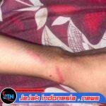 Diduga Jadi Korban Penganiayaan, Seorang Wanita di Kos Bulusan Kalipuro Alami Luka Memar, Pelaku Juga Disebut Terlibat Narkoba